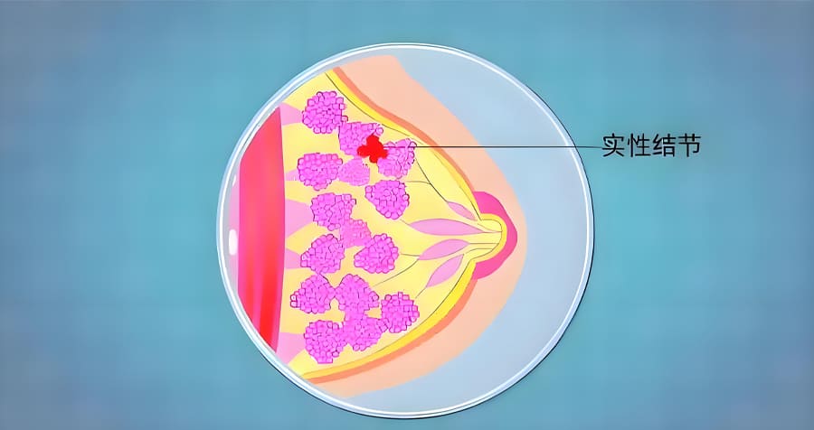 乳腺结节1