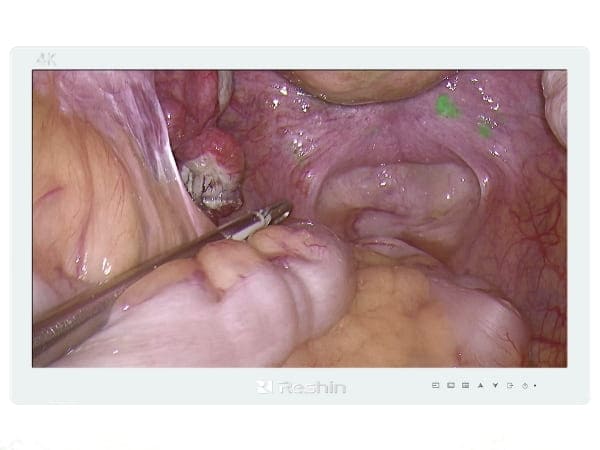 Reshin Full HD monitor displaying a crisp, detailed radiological image