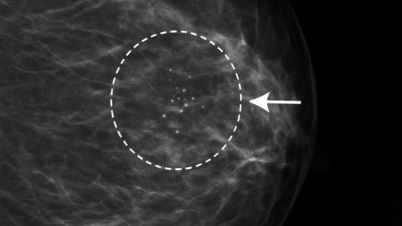 Close-up of a mammogram showing subtle microcalcifications