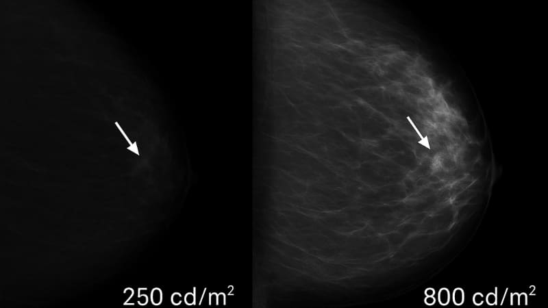 Split image showing same mammogram on dim vs bright monitor, with arrow pointing to subtle lesion