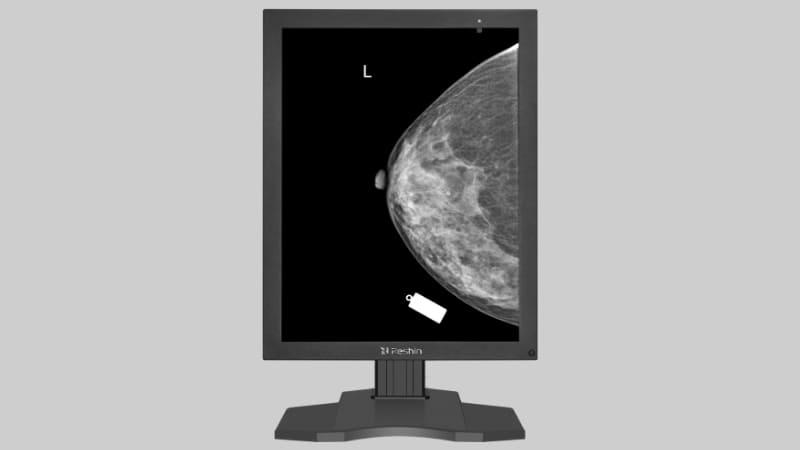 A Reshin 5MP medical monitor displaying a mammogram, with calibration tools nearby