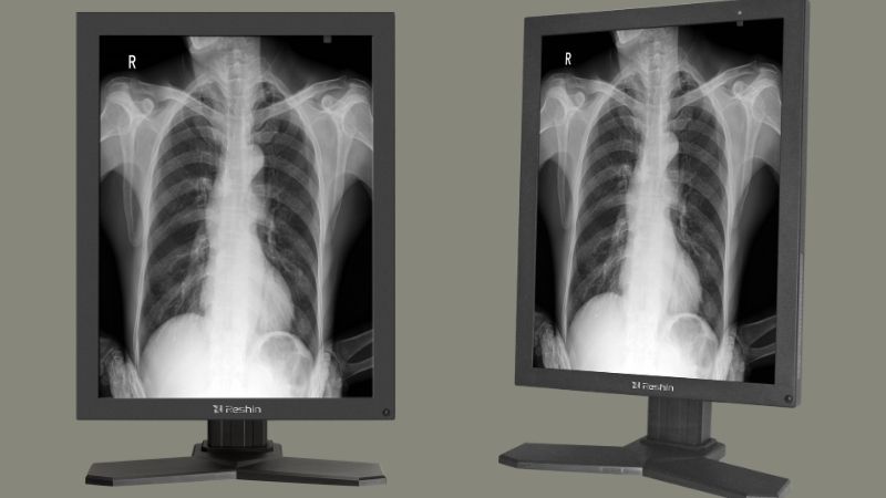 A Reshin 2MP diagnostic monitor, like the MD22CA, displaying a clear chest X-ray