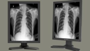 Reshin MD22CA 2MP diagnostic monitor displaying a clear chest X-ray with DICOM calibration in a clinical setting.