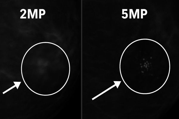 Close-up comparison of microcalcification visibility on 2MP vs 5MP