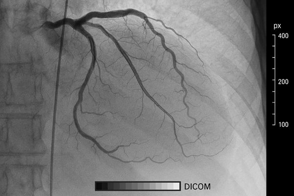 Close-up of a cardiac image on a high-resolution monitor, showing fine vessel details