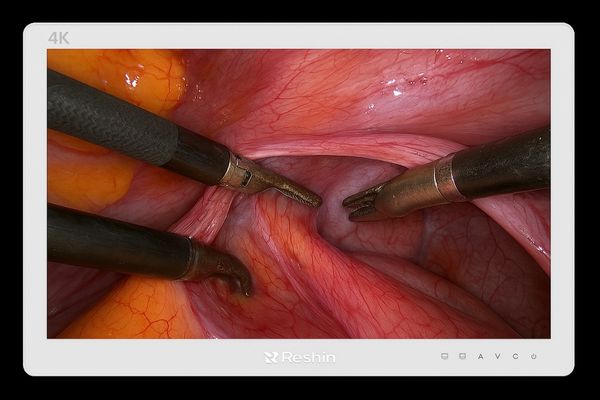 Close-up of a detailed surgical image on a monitor during a robotic procedure