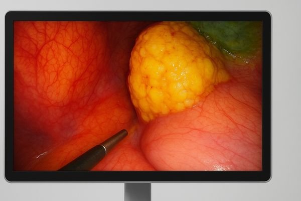 An image showing a vibrant endoscopic view on a medical display, highlighting the color differences between various tissues