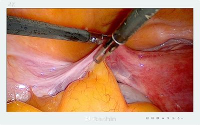 32-inch 4K surgical display showing high-definition laparoscopic surgery image