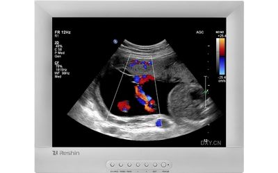 Reshin ultrasound display showing color Doppler ultrasound image