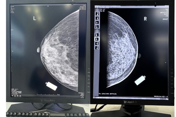 A dual-head 5MP mammography monitor setup showing digital breast tomosynthesis (DBT) images in a radiologist's reading room.