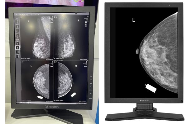 A radiologist at a workstation with a perfectly aligned dual-head 5MP monitor setup, showing CC and MLO views.