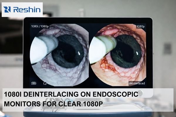 Endoscopic surgical monitor showing 1080i interlacing artifacts versus clean 1080p deinterlaced output for clear real-time viewing