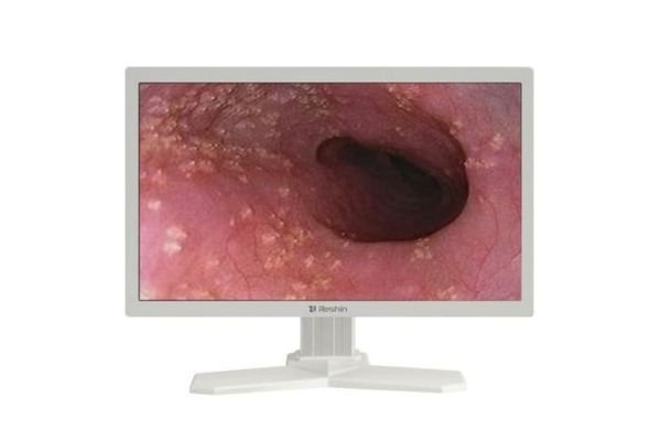MS220SA medical endoscopy monitor displaying clear view of anatomical structure during endoscopic procedure.