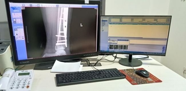 PACS display workstation showing an orthopedic X-ray image on a medical imaging monitor