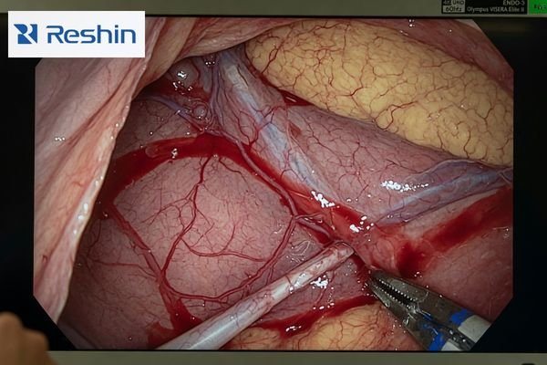 A surgical display showing natural tissue color and clear boundary separation during endoscopic viewing
